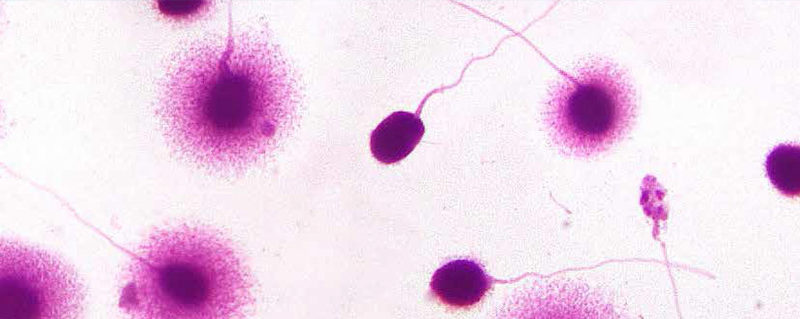 Il test di frammentazione del DNA spermatico